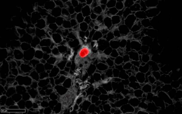 Medicina: Identificadas las células responsables de la recaída en el cáncer de colon